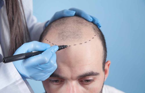 Hair transplant in Mumbai